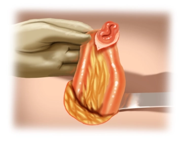 Mobilização do Intestino Delgado