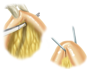 Suspensão da Alça Ileal