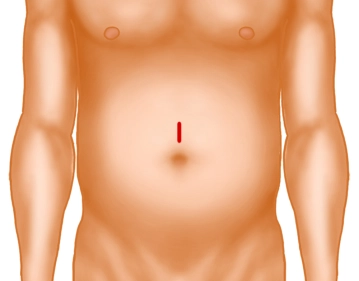 Incisão na Pele e Preparação na Fáscia