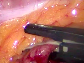 Transecção da Artéria e Veia Ileocólica