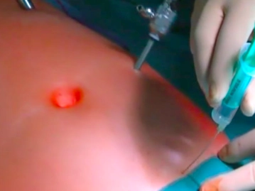 Inserção dos Trocateres de 5 mm; Posicionamento