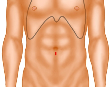 Acesso ao espaço pré-peritoneal