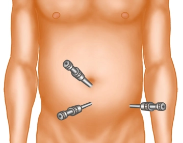 Inserção dos trocartes