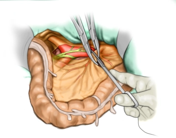 Transecção Central da Artéria Mesentérica Inferior