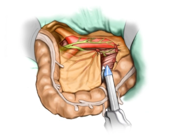 Ressecção do Cólon Descendente