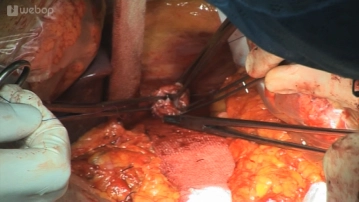 Amarrando a bigorna usando uma sutura em bolsa