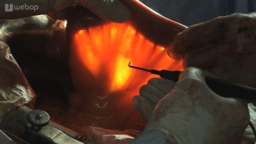 Avaliação das arcadas vasculares jejunais com determinação do comprimento do ramo aferente