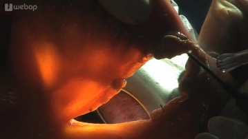 Preparação da alça em Y de Roux