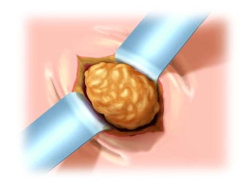 Preparação do Saco Herniário