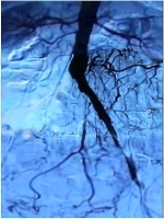 Pr&auml;operatives Angiogramm