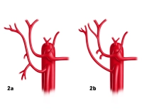 165_LAV_02_a_b_Leberarterie